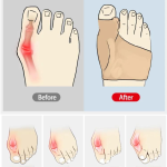 Bunion Corrector Toe Separator - Image 2